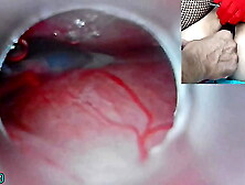 Asian Insemination with Sperm into Uterus and Endoscope Webcam by Cervix to watch inside womb Uncensored