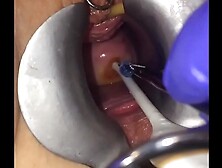 Cervix extreme gyno play