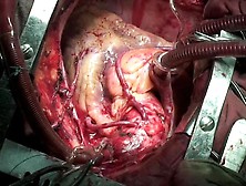 Simultaneous Cabg And Extended Right Hemicolectomy Cm. Avi