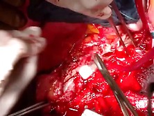 Open Thoracoabdominal Aortic Aneurysm Repair