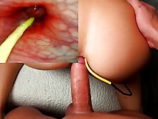 Amazing anal.  Webcam in Her Bum Deep Anal Fuck and Internal Cream pie