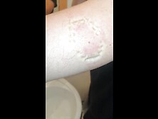 Girl Hard Biting Marks