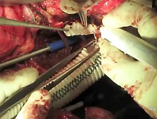 Open Thoracoabdominal Aortic Aneurysm Repair