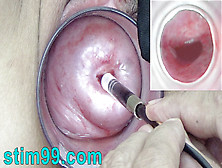 Japanese Endoscope Camera Inside Cervix Cam Into Vagina