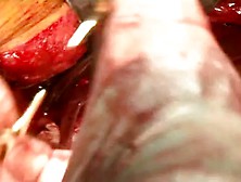 Open Abdominal Aortic Aneurysm Repair