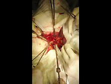 Open Abdominal Aortic Aneurysm Repair