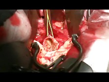 Open Abdominal Aortic Aneurysm Repair