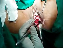 Vaginal Hysterectomy