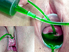 Cervix And Pee Hole Inflation With Injections For Japanese Lesbians