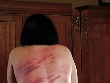 Numerous Whip Bruises On Milf's Back