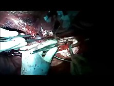 Open Thoracoabdominal Aortic Aneurysm Repair